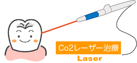 レーザー治療のイメージ図。