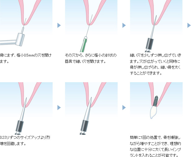 大口式インプラントの施術手順