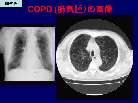 レントゲン 肺気腫